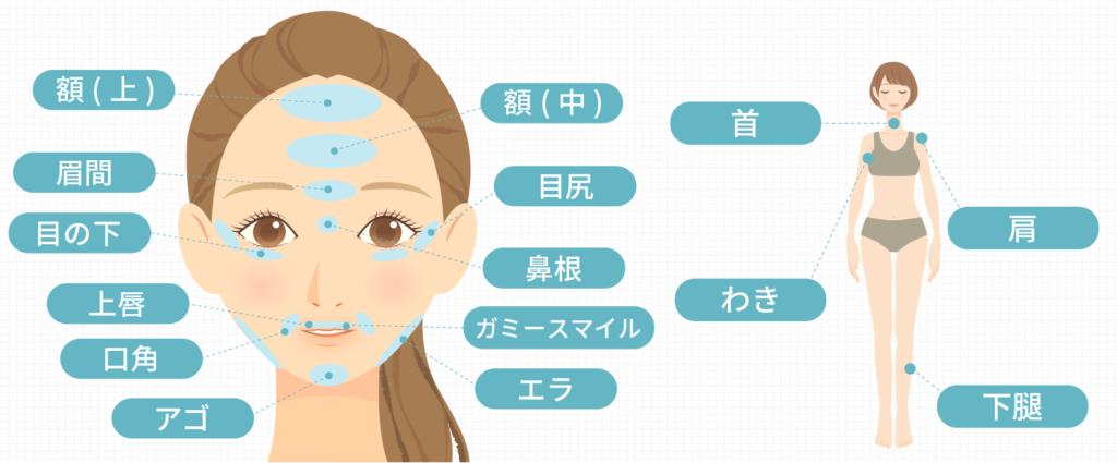 ボツリヌストキシン注射の施術部位