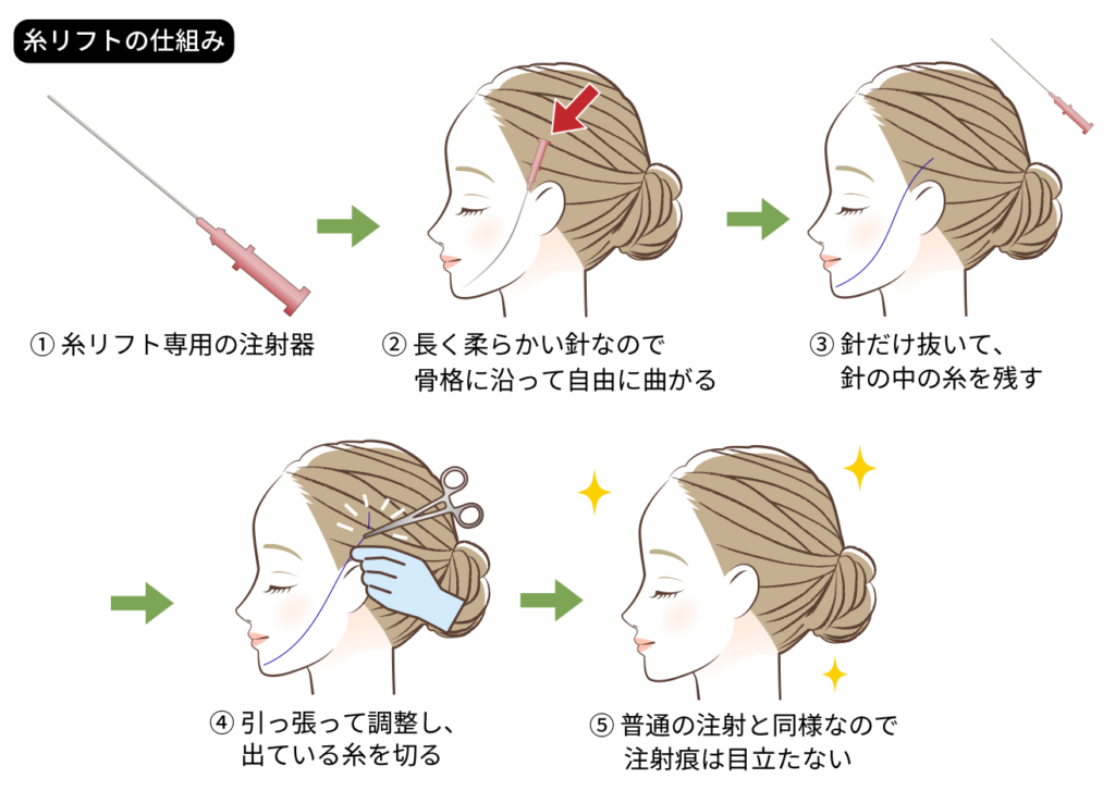 糸リフトの仕組みイラスト